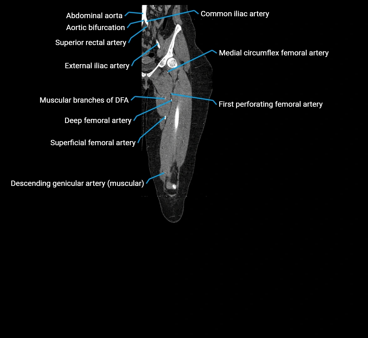 CTA lower limb coronal cross sectional anatomy labelled image _27 (3).webp